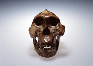 レーザー治療で太田母斑を消すなら